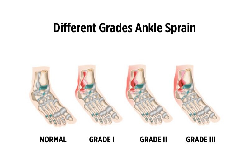 Ankle Sprain Grades