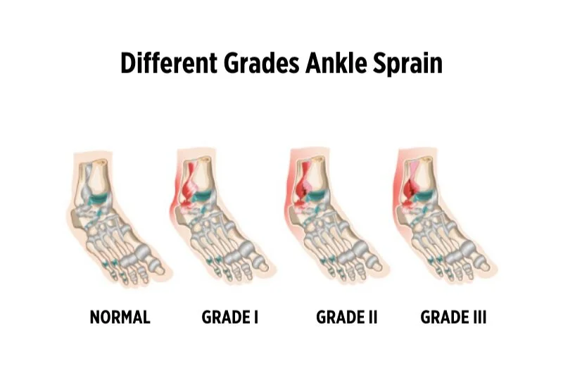The Various Types of Ankle Sprains — River Podiatry
