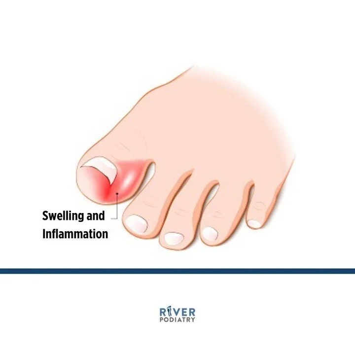 What are the Causes and Symptoms of an Ingrown Toenail? 