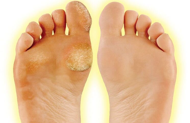 How to Get Rid of Calluses on Feet