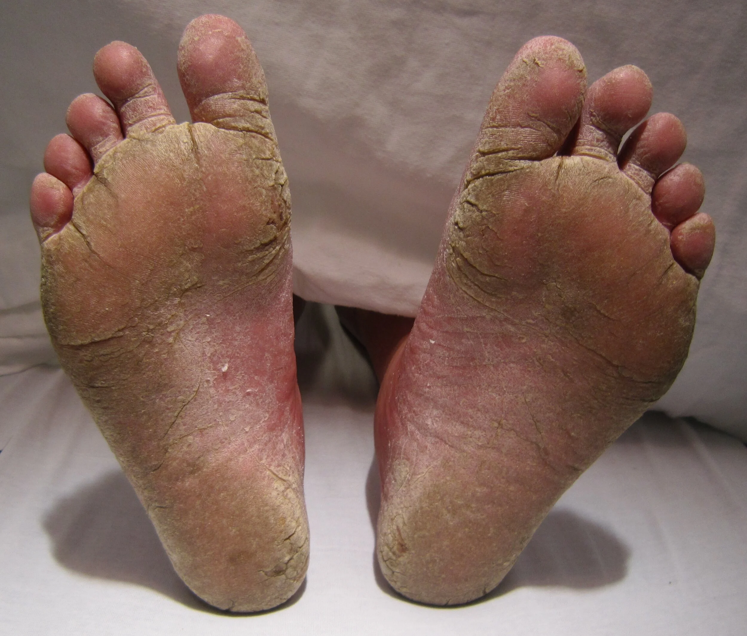 What is Athlete's Foot? 