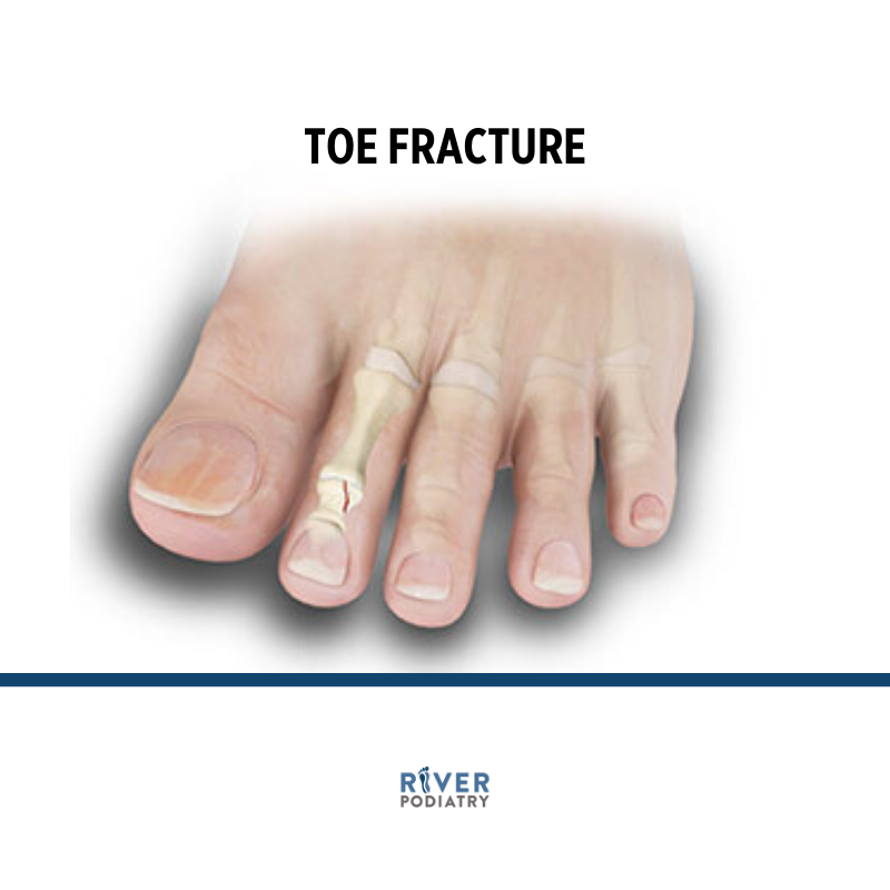 Toe Fracture