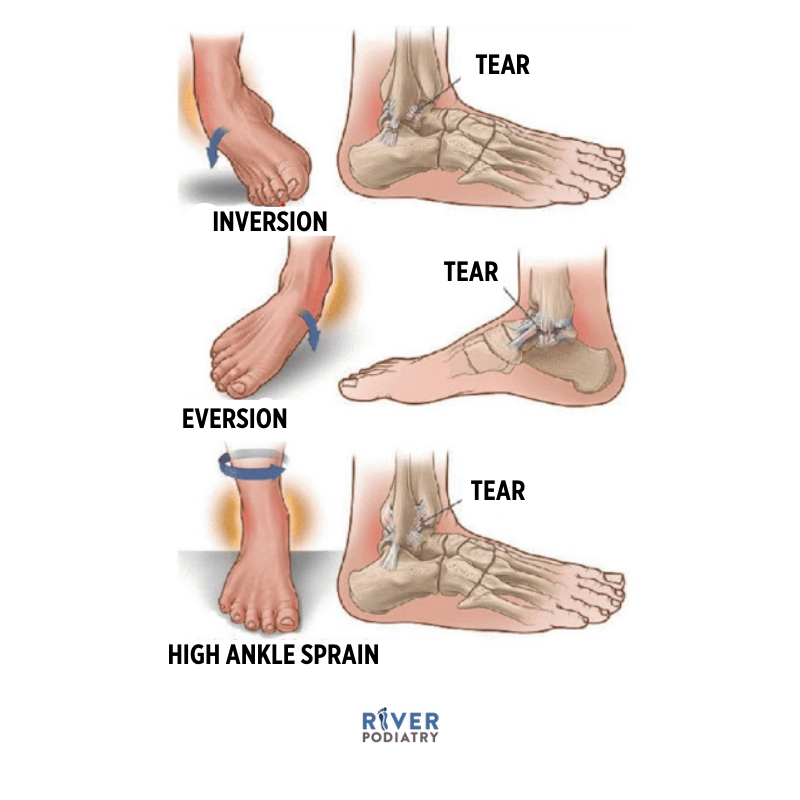 Ankle Sprain