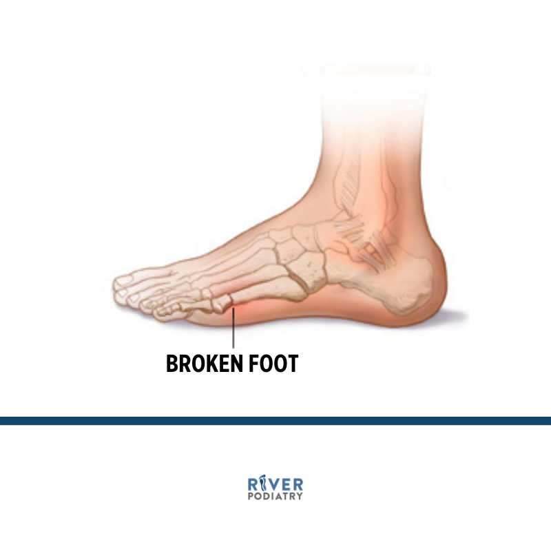 Foot &amp; Ankle Trauma