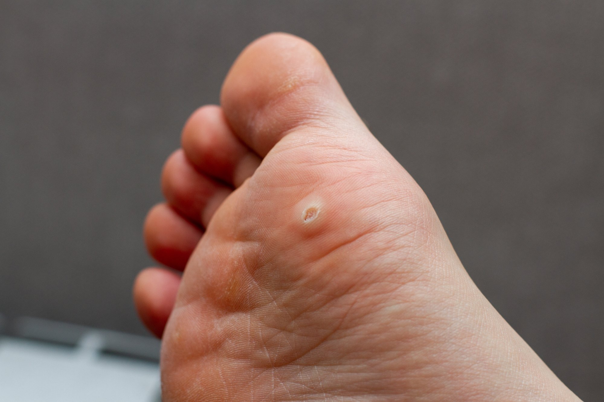 What you should know about Plantar Warts — River Podiatry I The Best