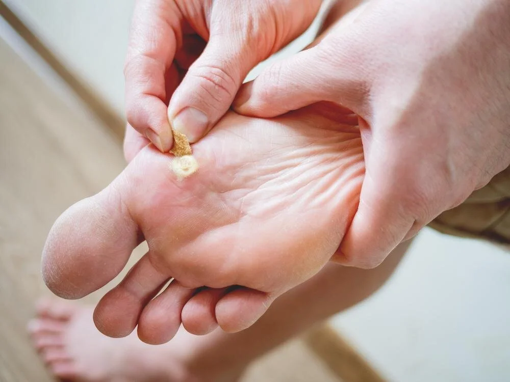 How to avoid and treat Plantar Warts