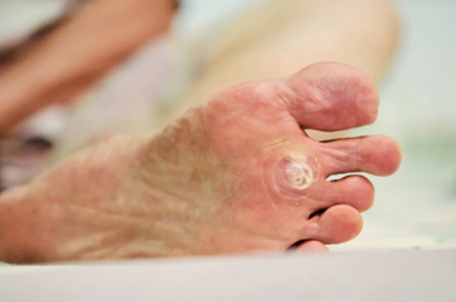 What you should know about Plantar Warts