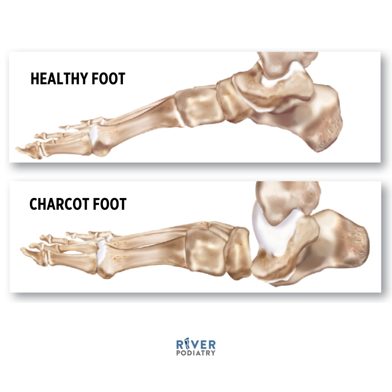 Charcot Foot