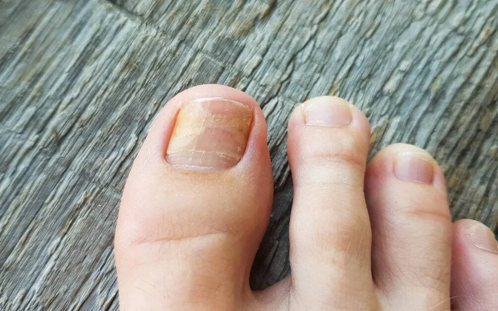 How Long Does It Take Your Toenail to Grow Back?