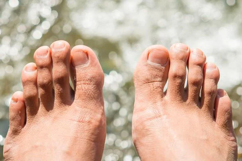 What Do You Do If You Have Hammer Toe?