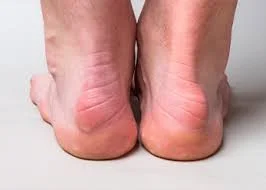 Do You Have Haglund’s Deformity?