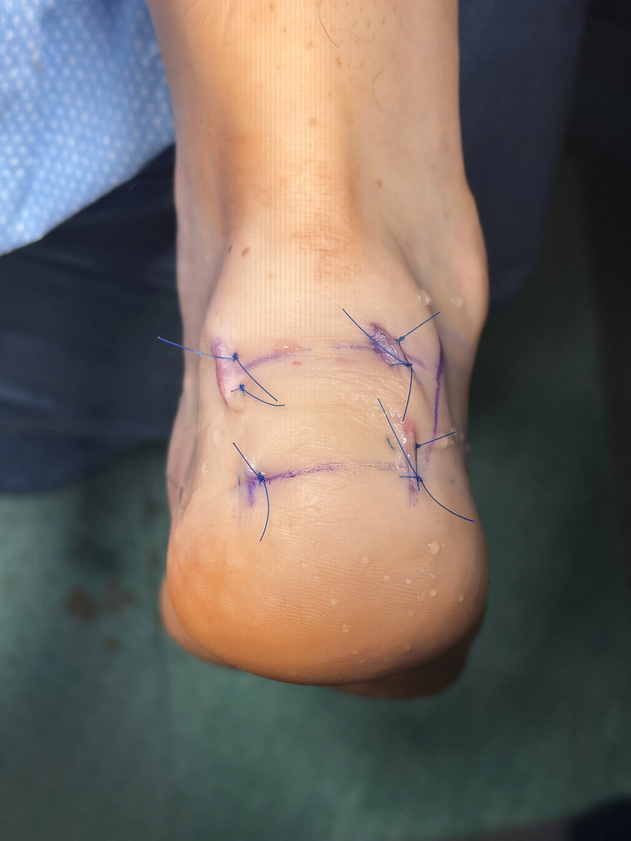 Stop Living with Chronic Heel Pain