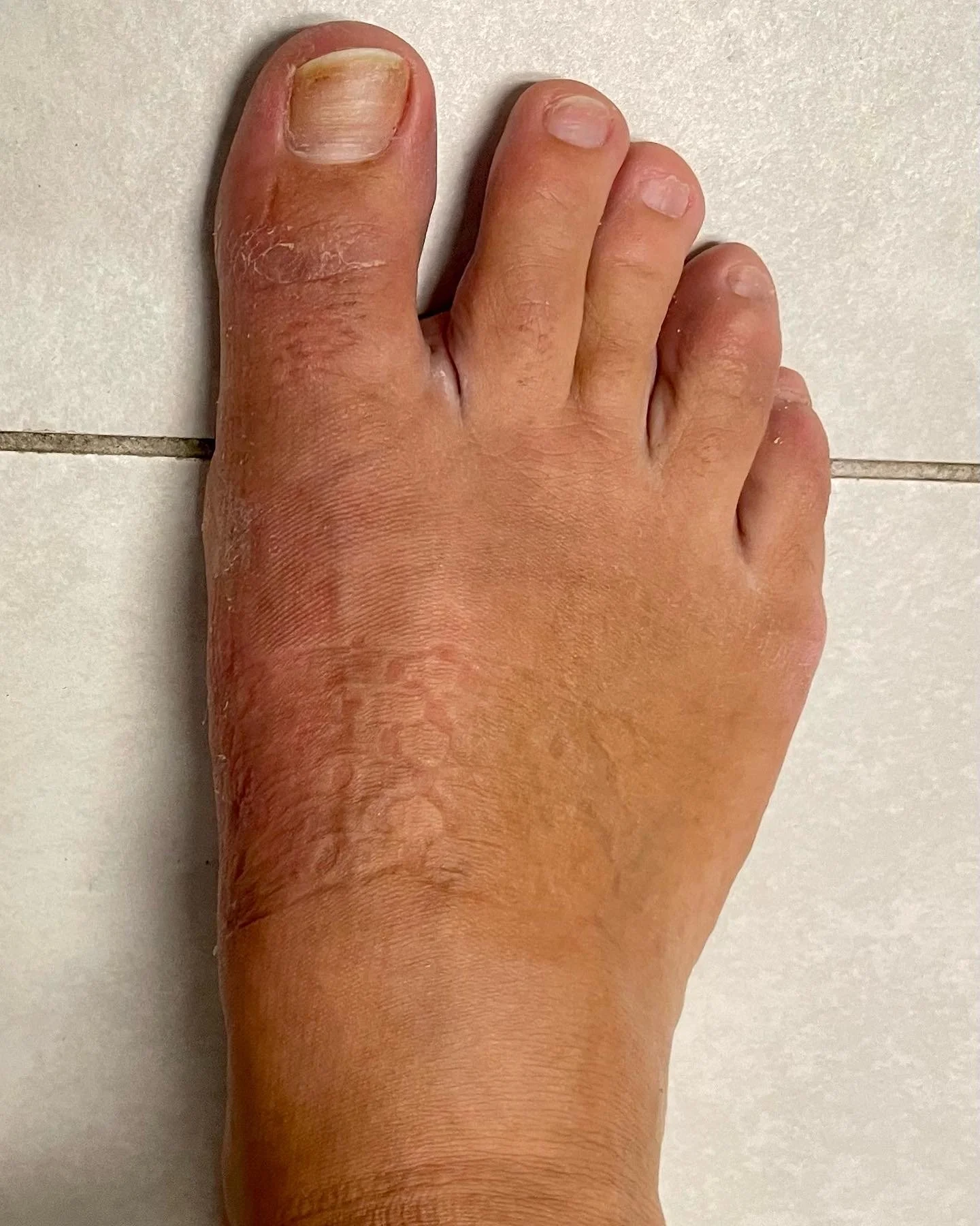 Why More Patients Are Choosing Minimally Invasive Bunion Surgery?