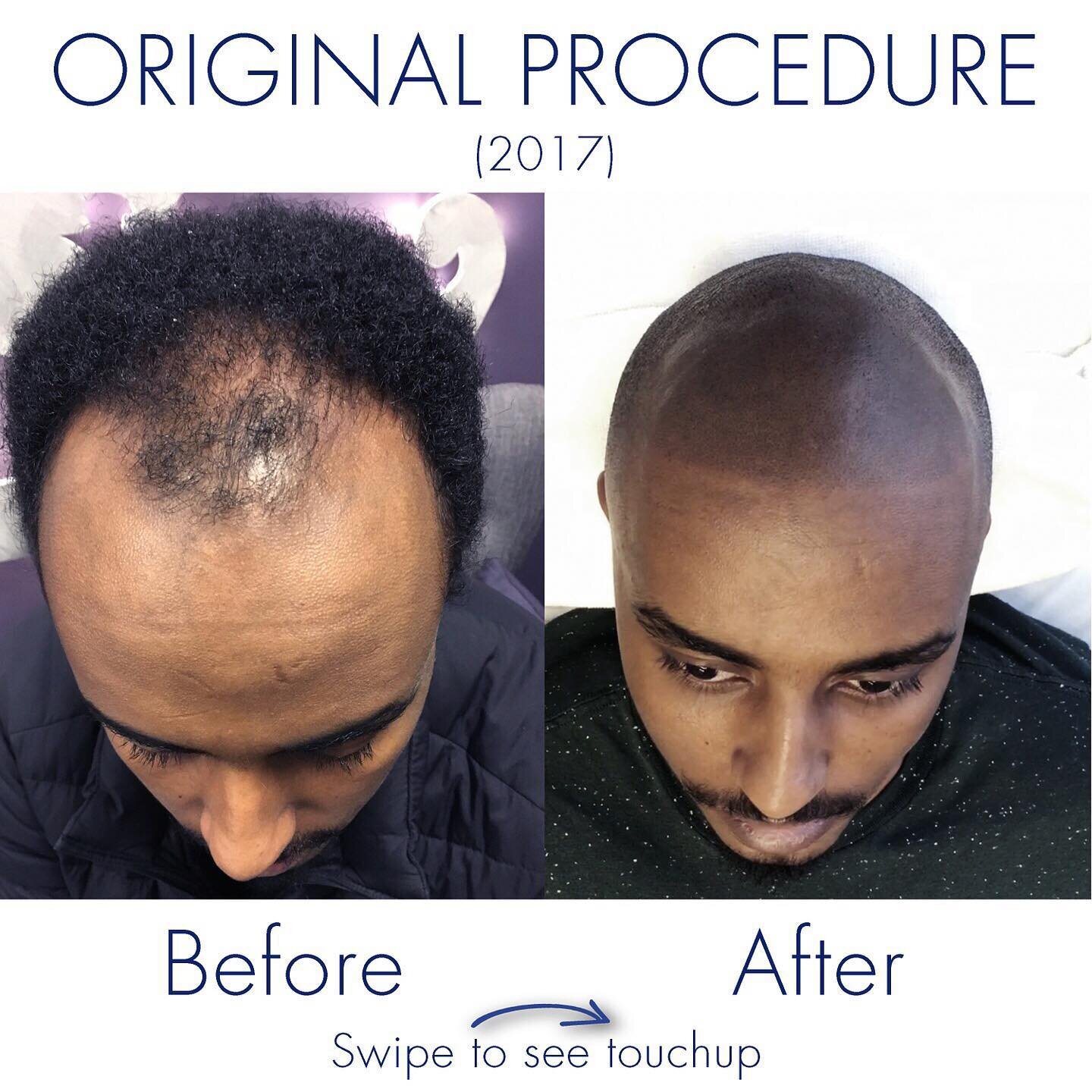 Although SMP can be performed alongside longer, visible hairs, it's best to keep existing hair short in order to achieve the most realistic, natural results. When performed correctly, the procedure can last for years before needing a touch up.

#SMPT