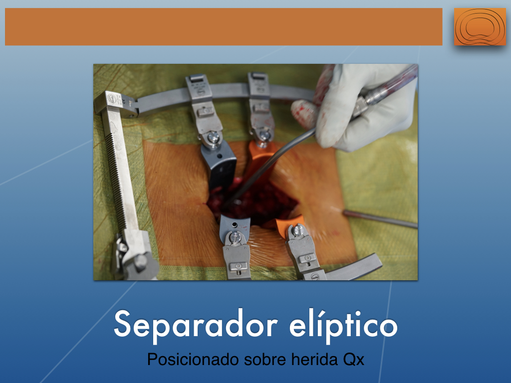 NSA Retractor Lumbar con Luz.033.jpeg