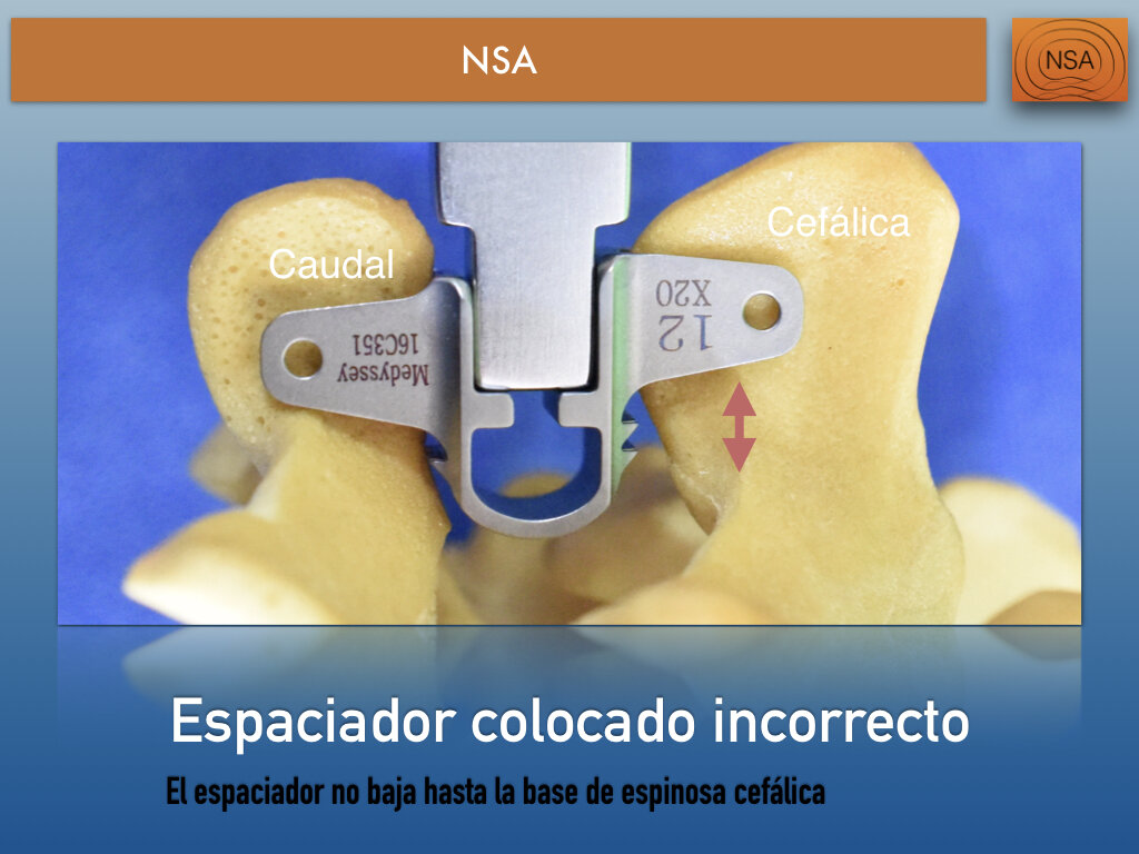NSA Espaciador Interespinoso Omega.010.jpeg