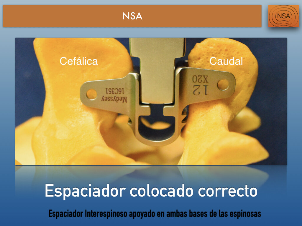NSA Espaciador Interespinoso Omega.011.jpeg