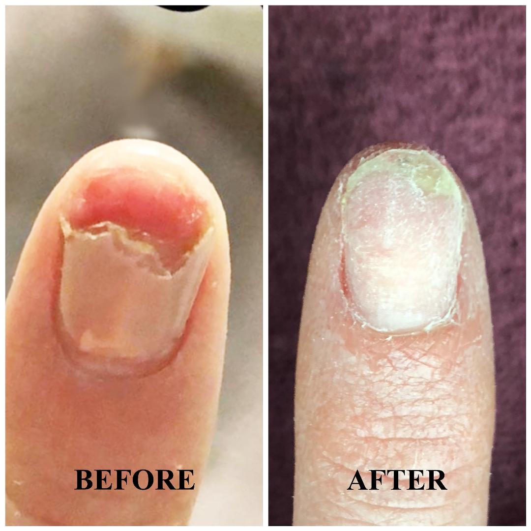 4-Week Fingernail Growth