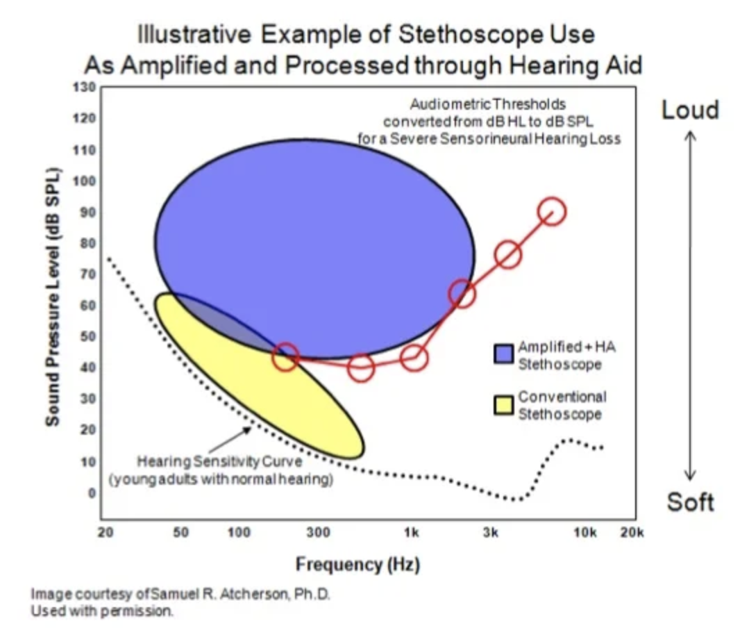 illustrates an example of what could be achieved with an amplified stethoscope through one’s hearing aids.