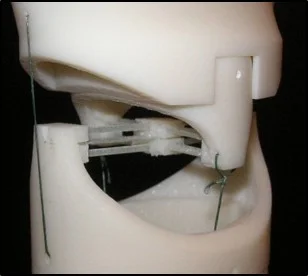 A compliant prosthetic mechanism can emulate the complexity of a joint such this compliant wrist joint.