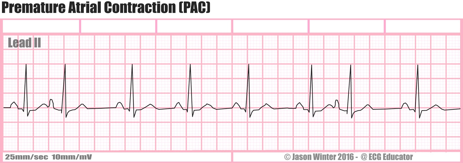 Patmac Are Premature Atrial Contractions A Sign Of Heart Disease? – NKAXF