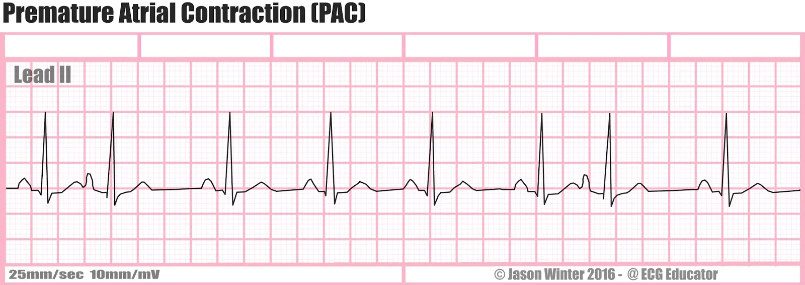 ( Source ) Note the abnormally shaped P wave and irregularity of the R-R measurements.