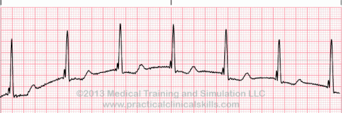 Matters Of The Heart Junctional Rhythms And Beats Patmac Rn