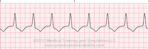 Matters Of The Heart Junctional Rhythms And Beats Patmac Rn