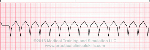 Matters Of The Heart V Tach Patmac Rn