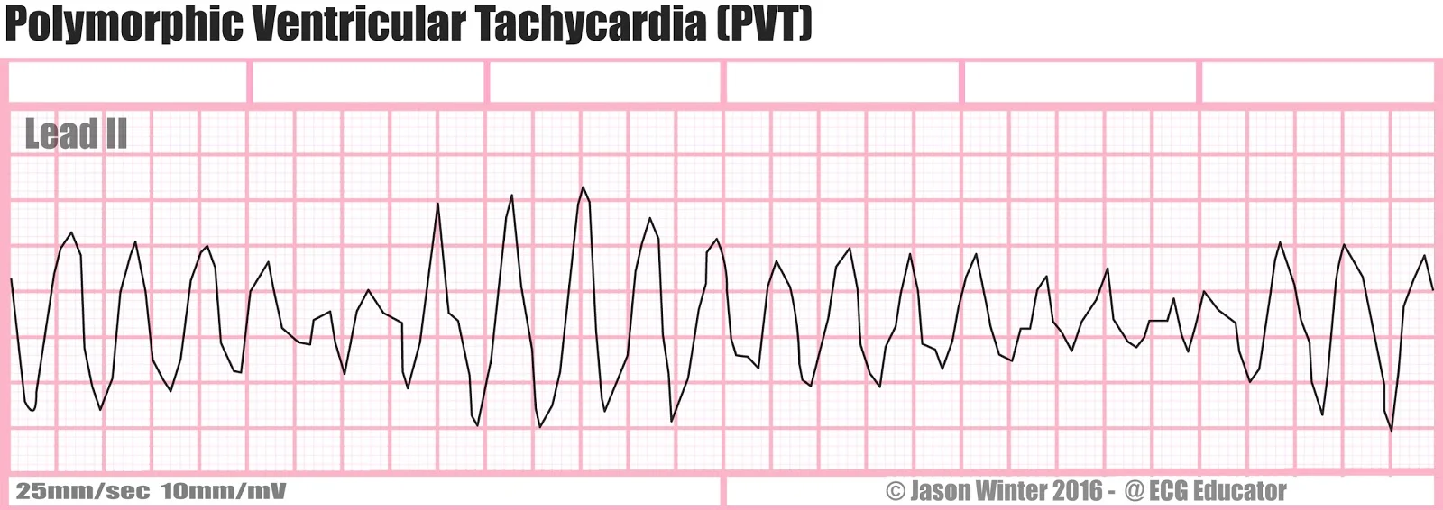 Patmac V Tach After Stent | What To Know About Ventricular Tachycardia (V-Tach ...