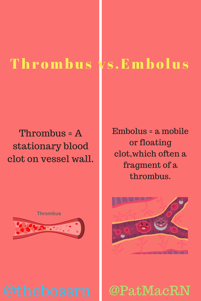 What Is Thrombus In A Thrombotic Stroke? – HQCWDZ