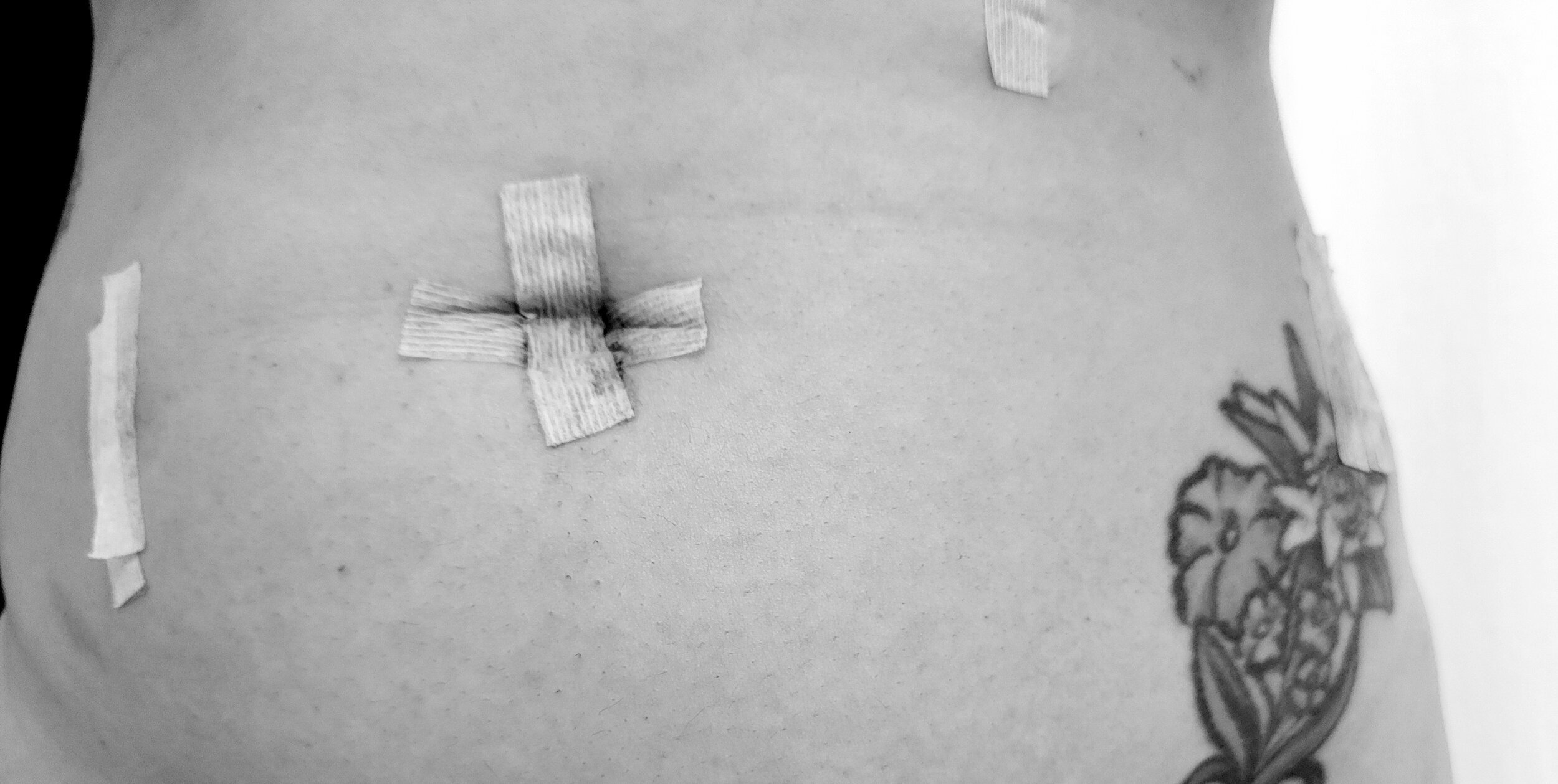 22 Years Without a Diagnosis: My Endometriosis Story