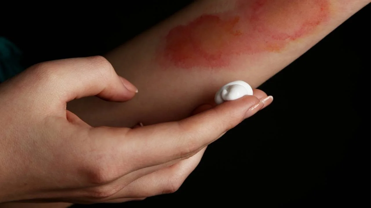 What To Put On A Burn Homemade Burn Salve