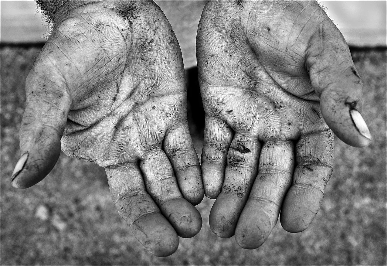 June 2017 Within weeks of having his finger amputated so he could find work, Dennis lands a demolition job paying $9 an hour. “I had to go back to work. I gotta pay my bills. If not, I’m homeless and I sleep on the street and I wake up with a blanket, people staring down at me with a blanket over me. I don’t want that. If I can work — that’s all I ever knew. You’ve got to work for your keep.” Even after being promoted to job superintendent three weeks later, Dennis says his boss is two weeks behind paying him. Within a few more weeks, after spitting up blood, Dennis learns he has inoperable lung cancer. Dennis doesn’t tell his boss about the caner, fearing he will lose his job, and keeps on working, even on days he has chemo treatments.
