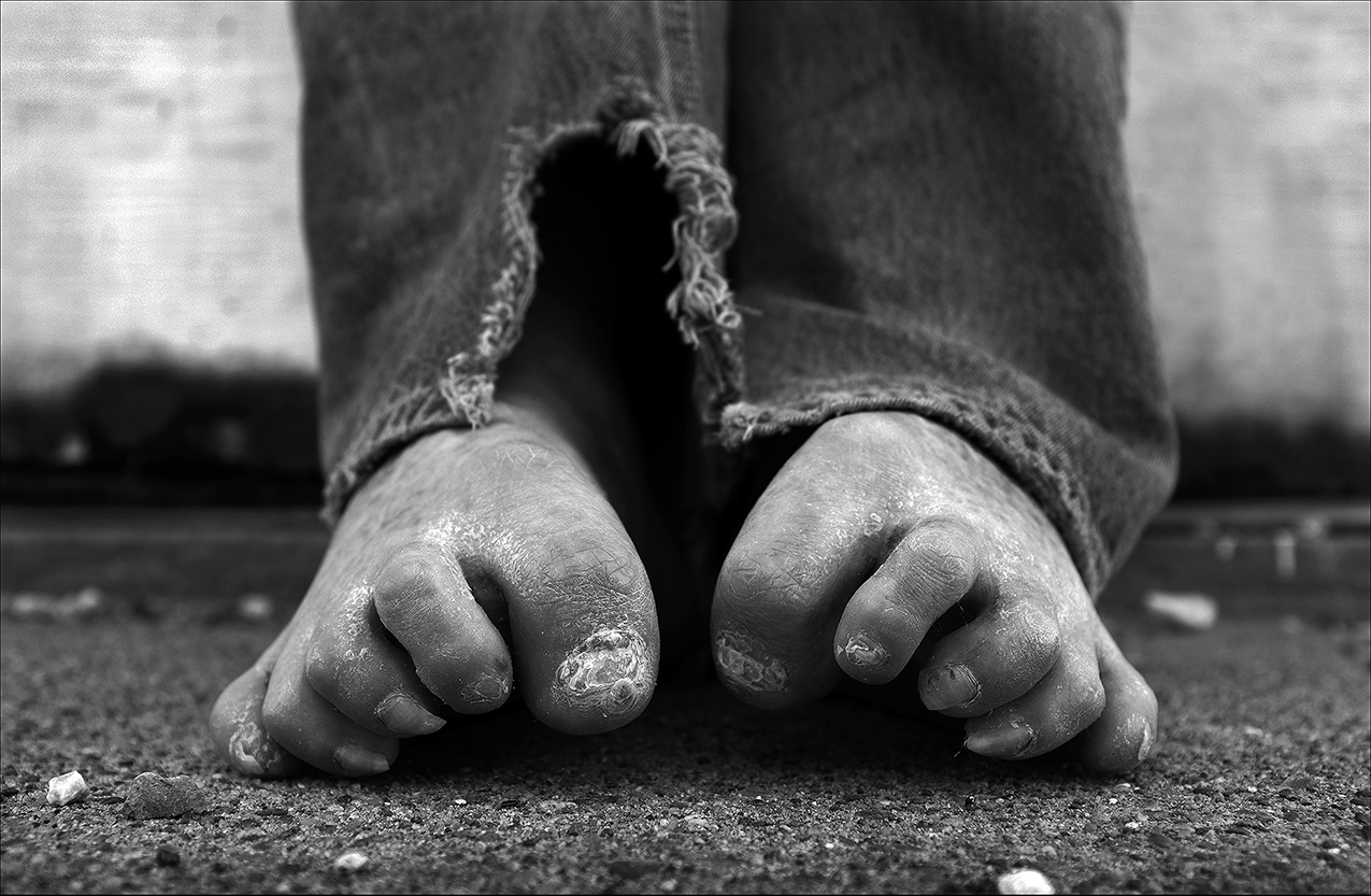February 2017: Steve claims inadequate care resulted in permanent injuries to his feet. “They didn’t do any exercising to my feet or legs (while in the coma). They told my dad that there was no use, that I was going to be brain-dead. They didn’t exercise my feet or my toes, or stretch none of my ligaments out, so everything shriveled up.” Steve says he refused amputation. Walking the five blocks to a local soup kitchen that he relies on for meals each day is an exercise in pain. He says he has difficulty getting pain medication and blames that on the current opioid epidemic. “Doctors just look at me like I’m just, I don’t know, like I’m a drug addict or something because I ask for pain medication. It’s hard to be in pain every day. I’ve been up at the fourth floor at Blessing Hospital here in Quincy, Illinois like three times now for attempting to kill myself, because I was tired of being in pain. There's nobody around here that will touch me or help me. It just, it's upsetting.”