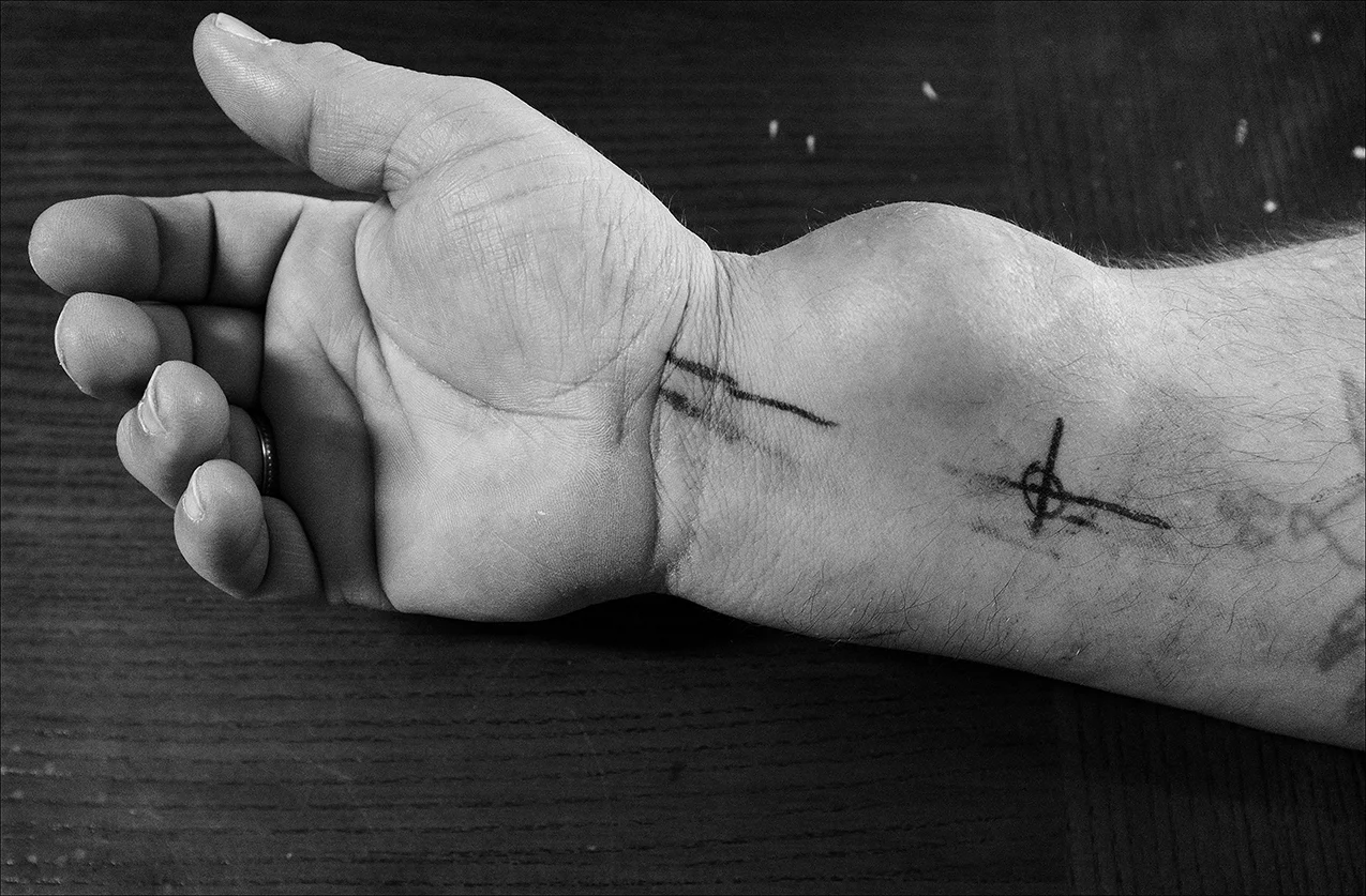 April 2017: The markings from his first radiation treatment outline Chris’ cancerous tumor on his wrist. Chris says a doctor removed a small bump on his wrist 3 years earlier, didn’t test it for cancer and said it wasn’t anything to worry about, but…