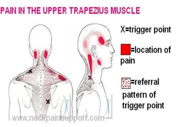 Trapezius pinched nerve