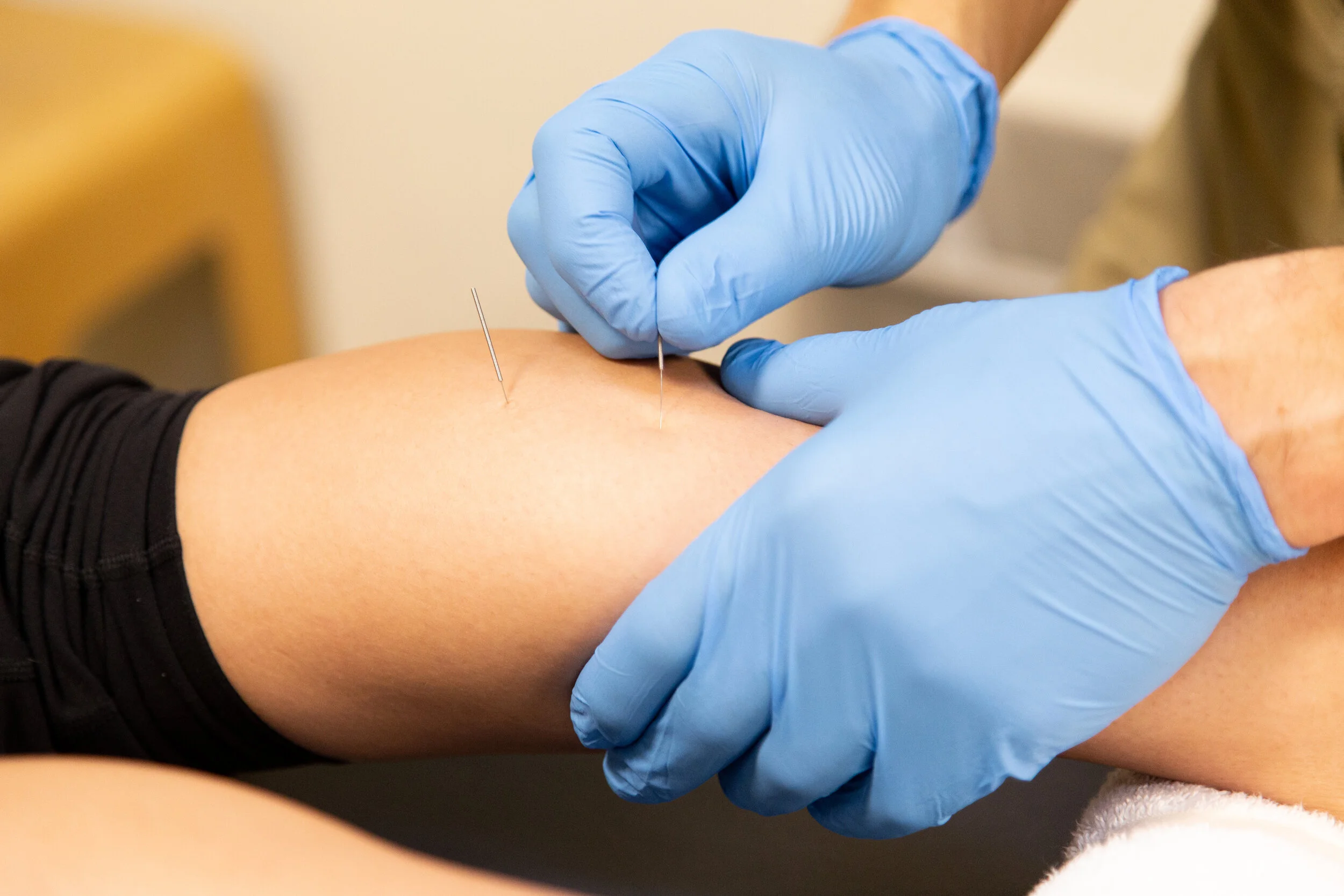 Dry Needling for PillFree Pain Relief — Precision Osteopractic