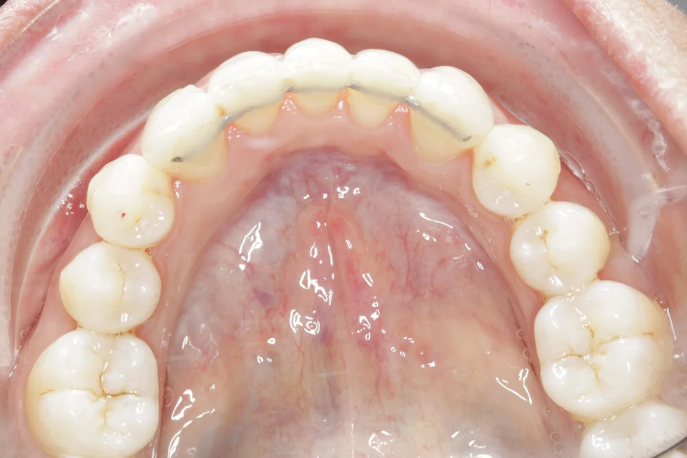 Invisalign Tooth Extraction Invisalign with a Dental Extraction — Dental Smiles Takeley