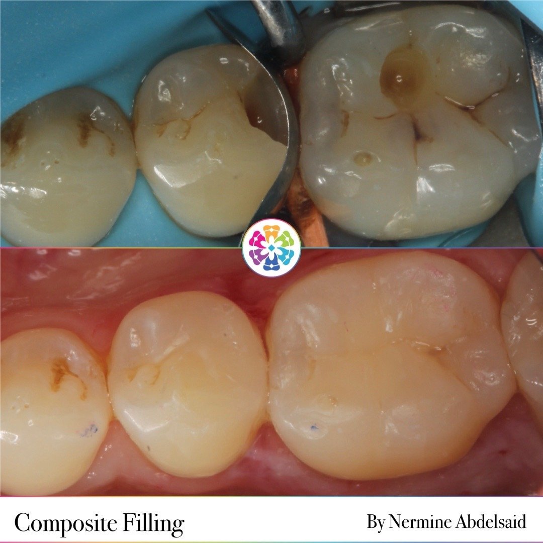 Composite Fillings 🦷

Decay removed and restored with tooth coloured filling material 

Contact re-established using sectional matrixes and wooden wedges. This prevent food trapping 🪥

#dentist #dentistry #dentalsmiles #dentalsmileschelmsford #dent