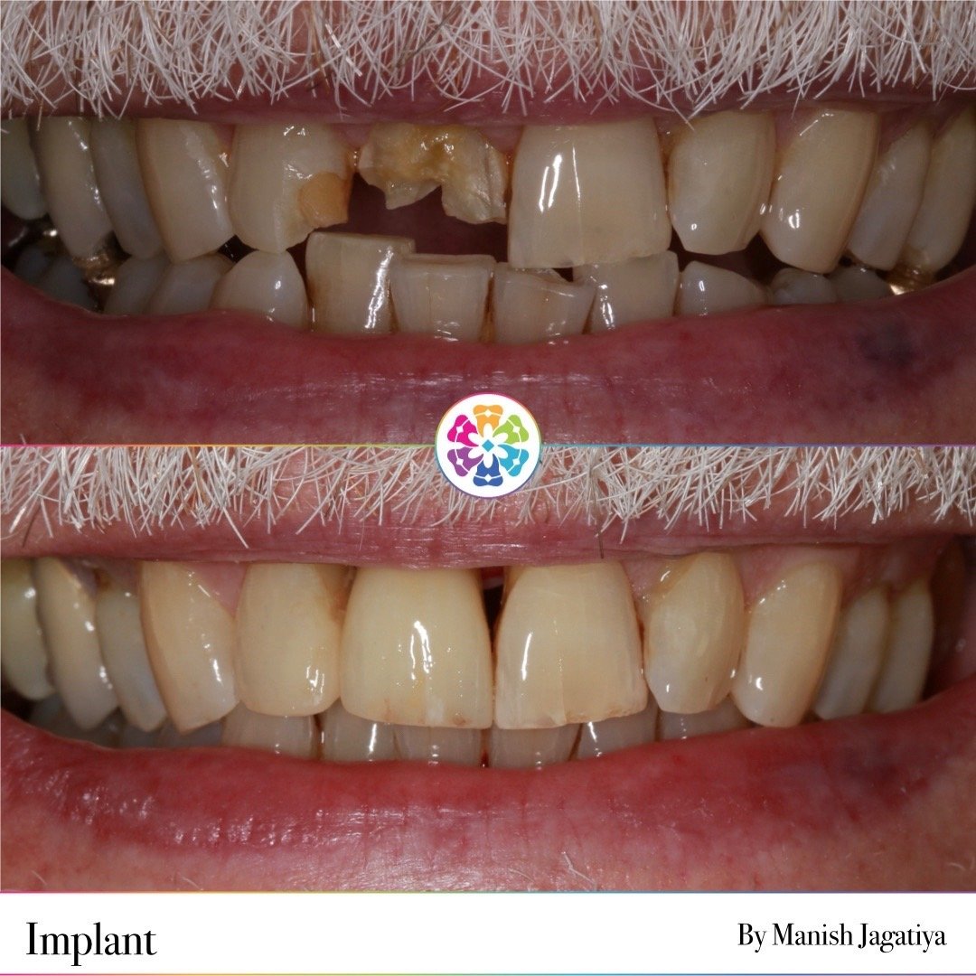 Front tooth implant 🦷

This patient opted for a single tooth implant as a replacement option 🦷

How natural does this look! The lab technician was able to recreate the aesthetics of the surrounding teeth ✨

#dentist #dental #dentalsmiles #dentalsmi