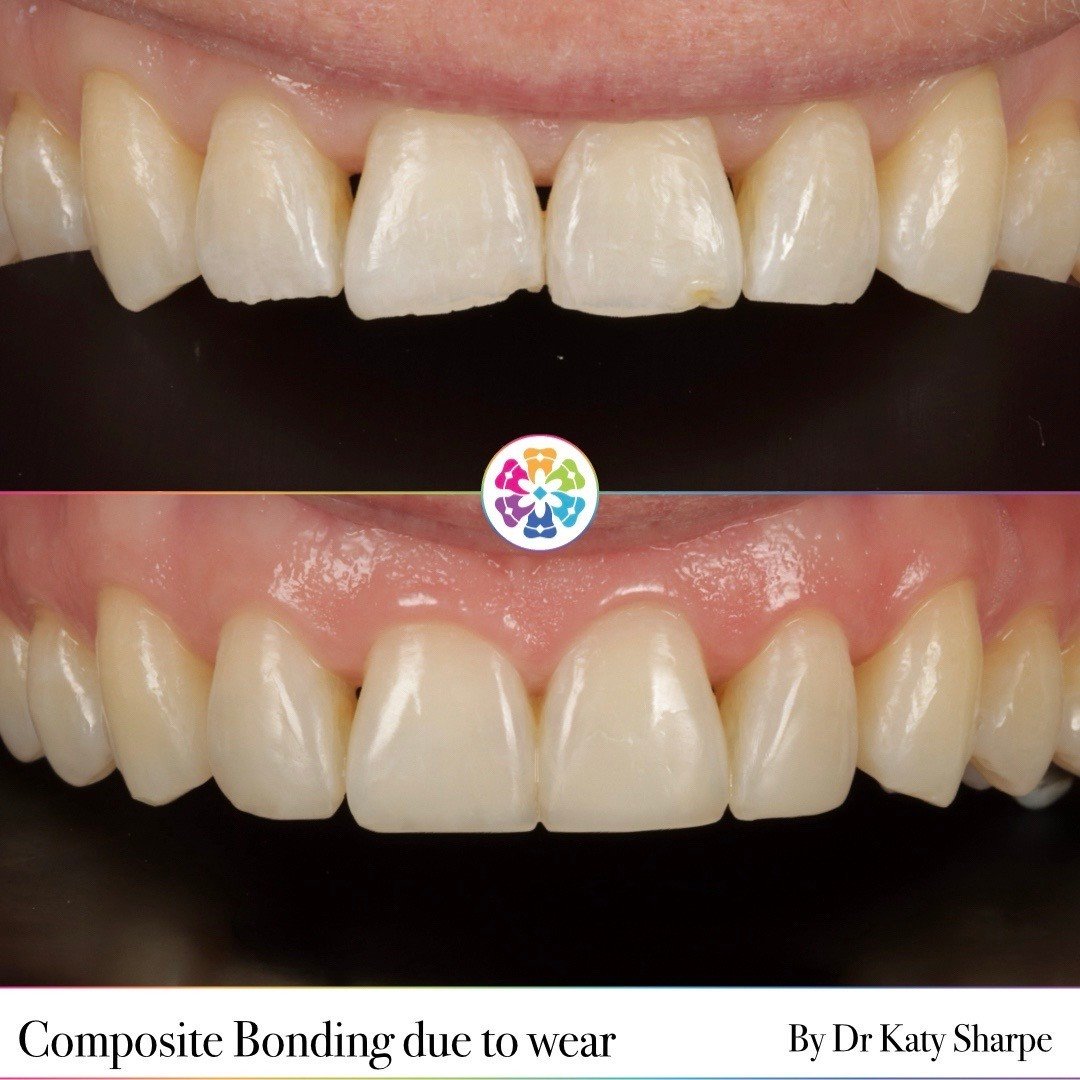 Composite Bonding ✨

After this patient had Invisalign to correct the bite, composite bonding was carried out to restore the worn edges 💎

What a difference! 🦷

🦷 Dr Katy Sharpe
📍 Dental Smiles Flagstaff

#dentist #dentalsmiles #dentalsmilesessex