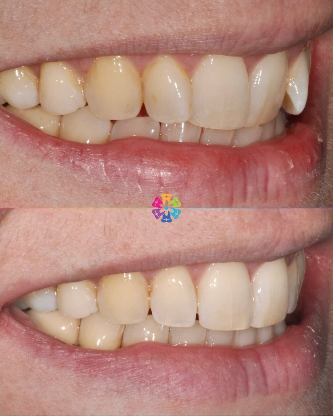 Before &amp; After Invisalign 🦷

This patients main concern was the rotated teeth on the top arch, and the crowding on the lower arch, this was corrected using Invisalign in 12 months!🤩 

Check out the clincheck video to see how this was achieved! 