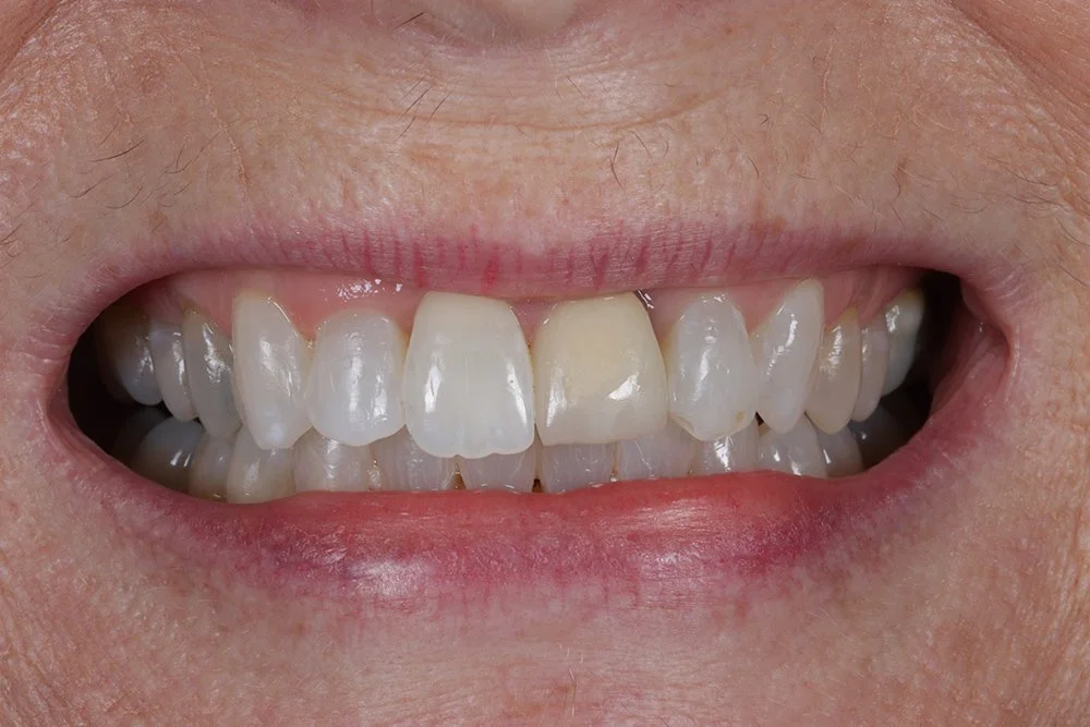 Porcelain-Onlays-and-Crowns-before.jpg
