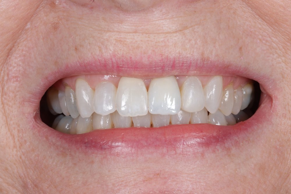 Porcelain-Onlays-and-Crowns-after.jpg