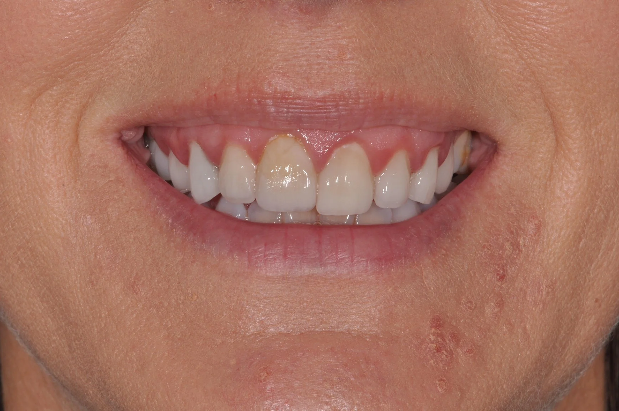 Before Veneers