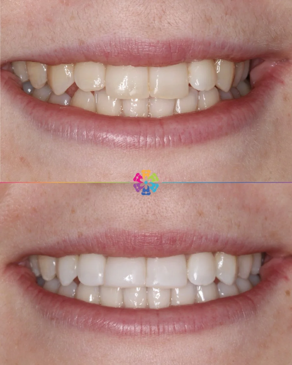 Invisalign Whitening & Composite Bonding ✨
Just 8 months from consultation to completion! ⏱️
#dentist #dentalsmiles #dentalsmilesessex #dentalsmileschelmsford #dentalsmilesessex #dentalsmilestakeley #essex #compositefillings #veneers #invisalig