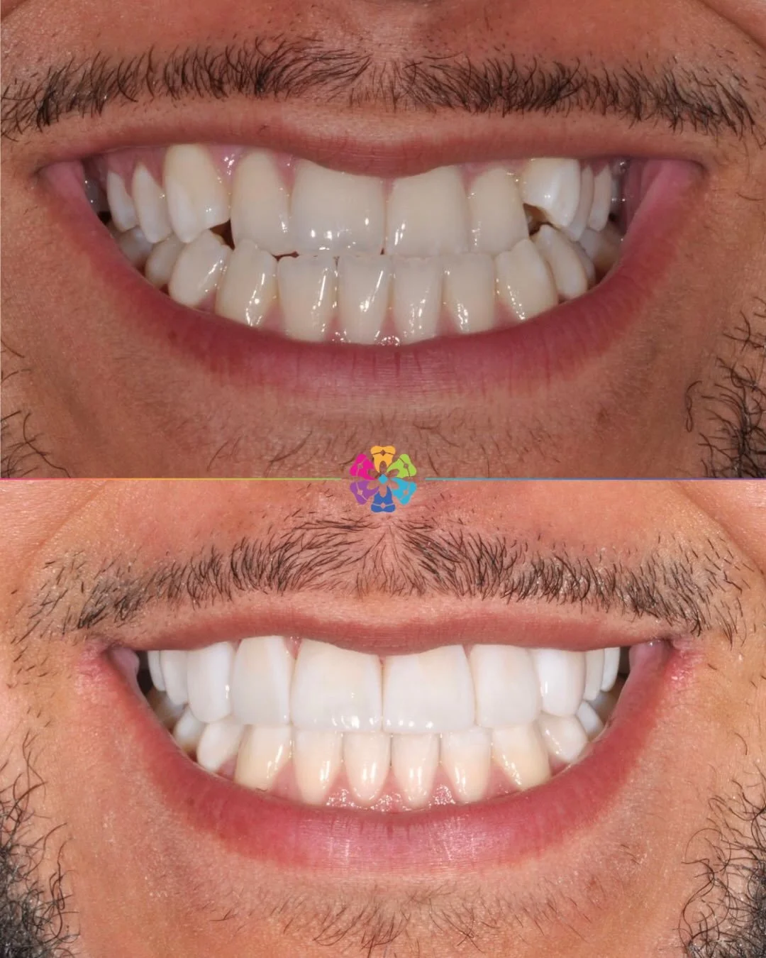 Invisalign with elastics, Whitening &amp; Bonding 🦷

Dr Dan Golebiowski working his magic transforming smiles. 

This Invisalign case was quite complex due to the position of the bite. 

Using elastics, the lower teeth were bought back and the front