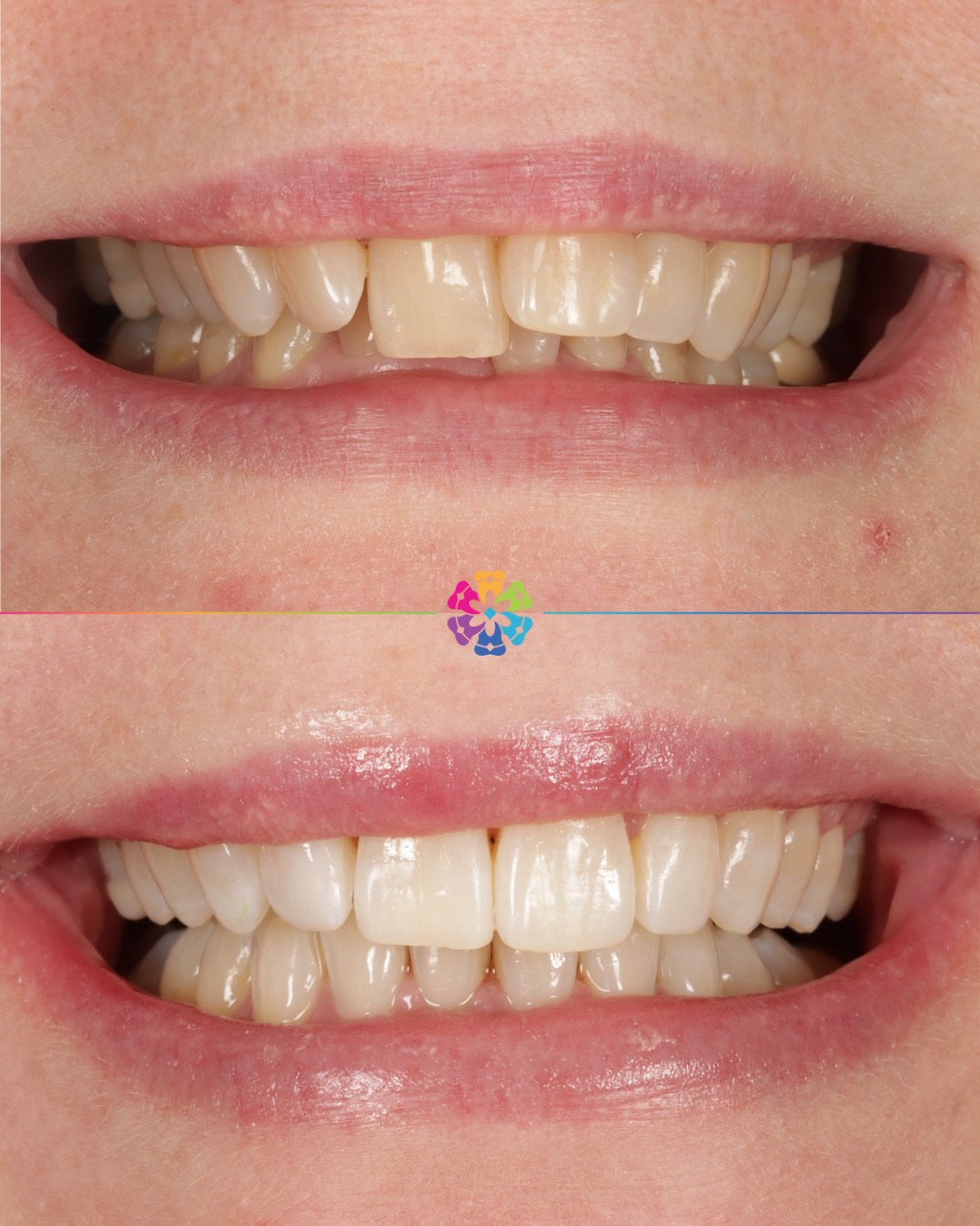 Invisalign Magic 🪄

Creating beautiful smiles to last a lifetime 🌟

Start you Invisalign journey today! We offer FREE consultations 🦷

#dentist #dentalsmiles #dentalsmilesessex #dentalsmileschelmsford #dentalsmilesessex #dentalsmilestakeley #essex