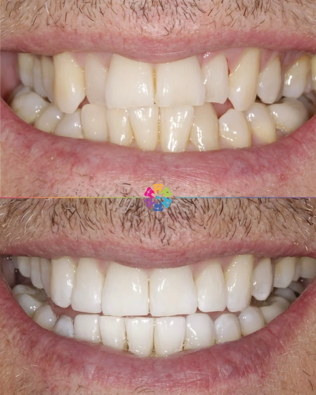 Invisalign and Whitening transformation in just 9 months! 🌟

Incredible results by Dr Andy Sharpe 🦷

#dentist #dentalsmiles #dentalsmilesessex #dentalsmileschelmsford #dentalsmilesessex #dentalsmilestakeley #essex #compositefillings #veneers #invis